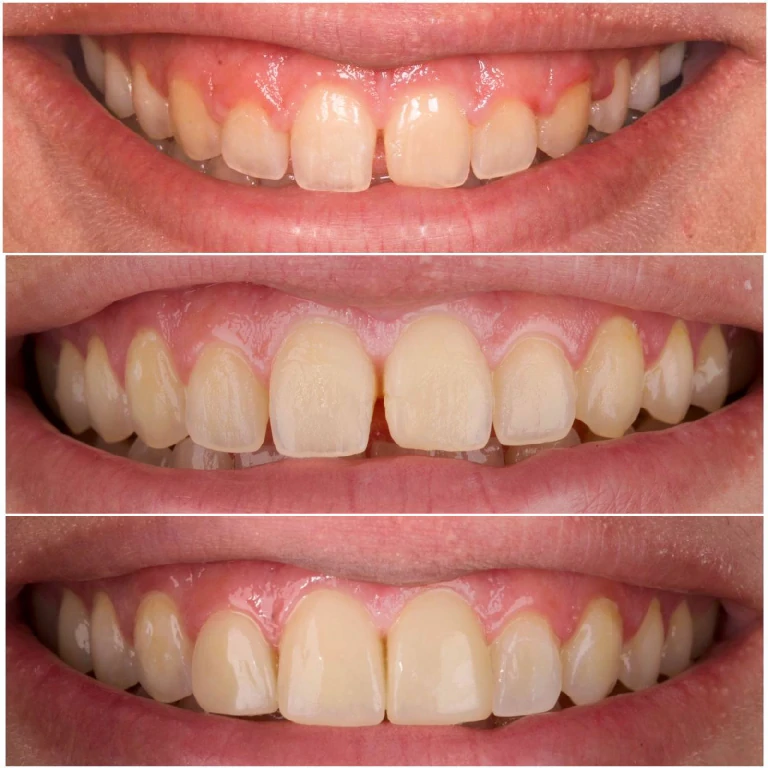 Caso de éxito - Alargamiento Coronario