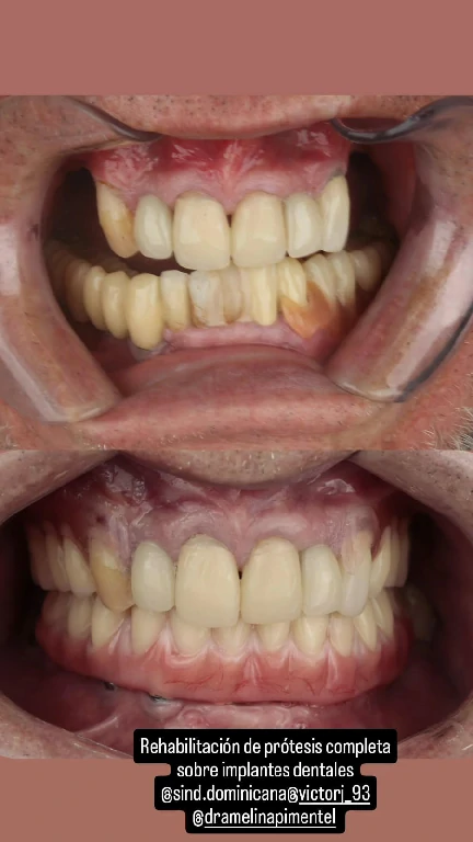 Rehabilitación protésica