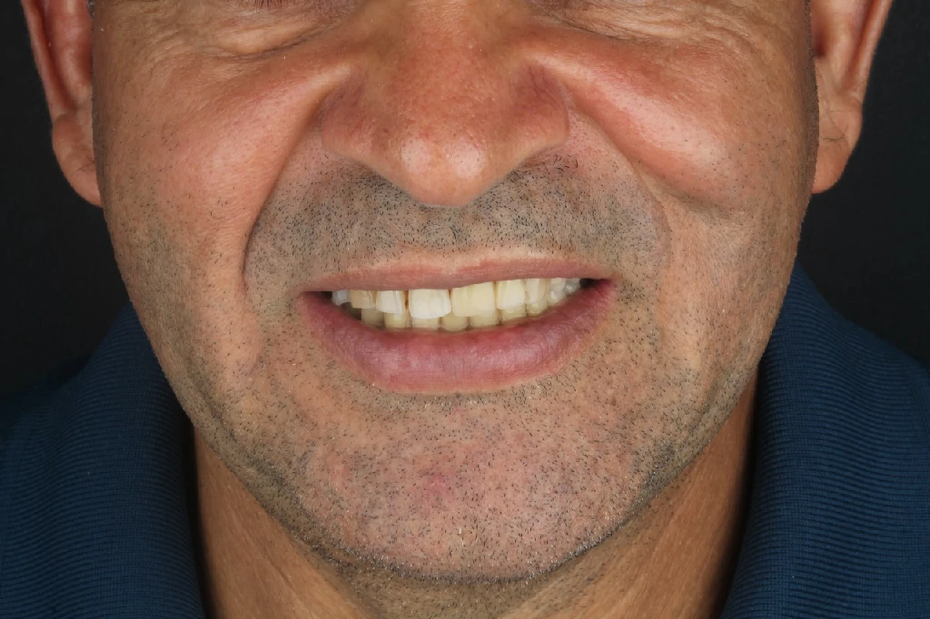 Rehabilitación protésica