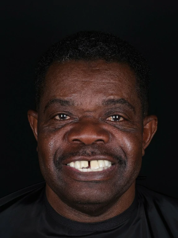 Rehabilitación protésica