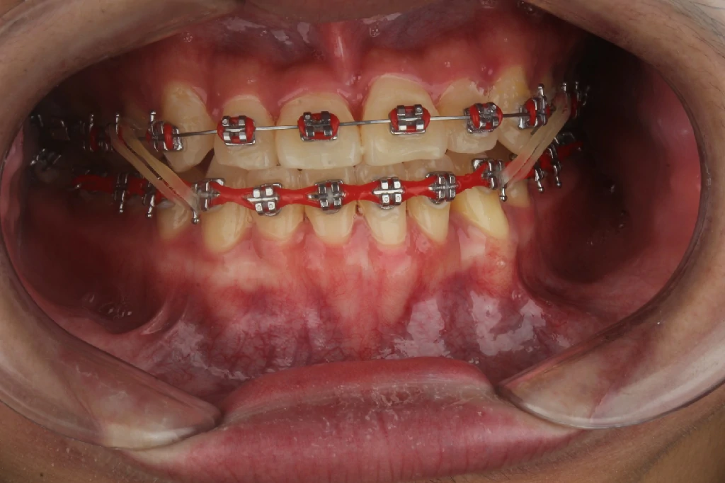 Caso 4 - Ortodoncia