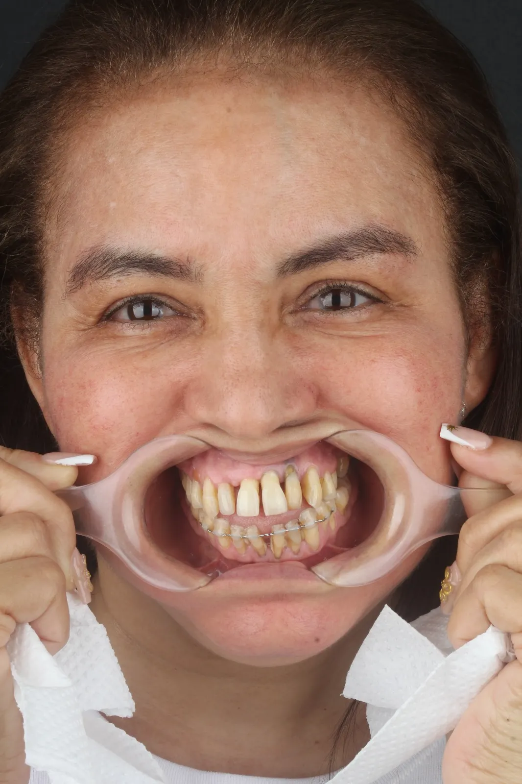 Paciente — cirugía digital, rostro