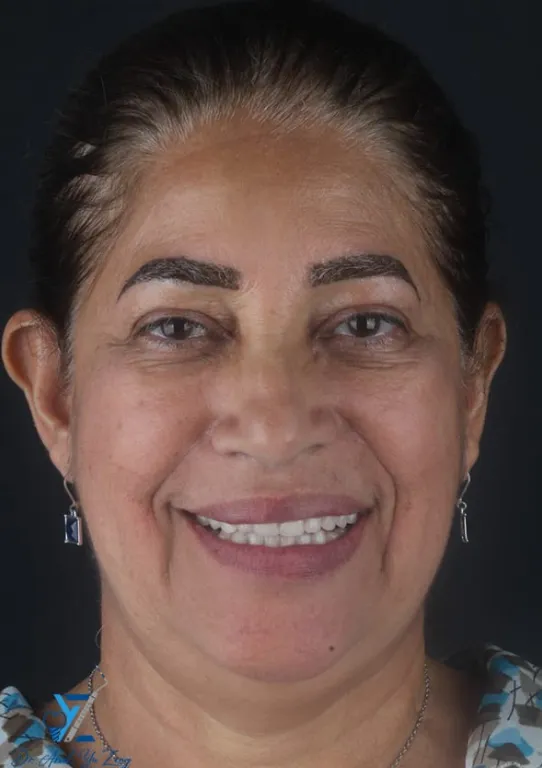 Rehabilitación completa protésica