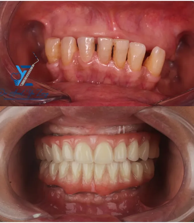 Rehabilitación completa protésica