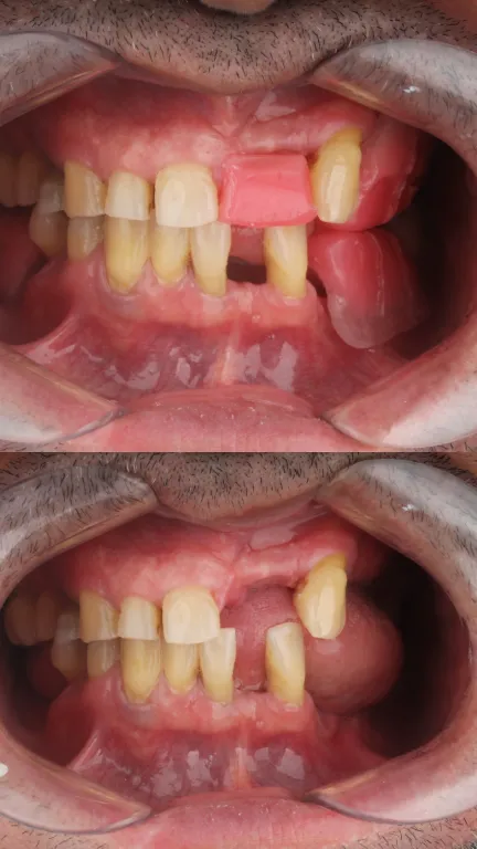 Rehabilitación protésica