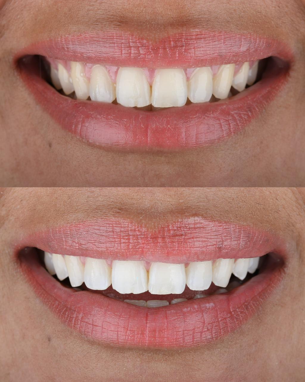 Resultado del blanqueamiento dental - Cliente 1