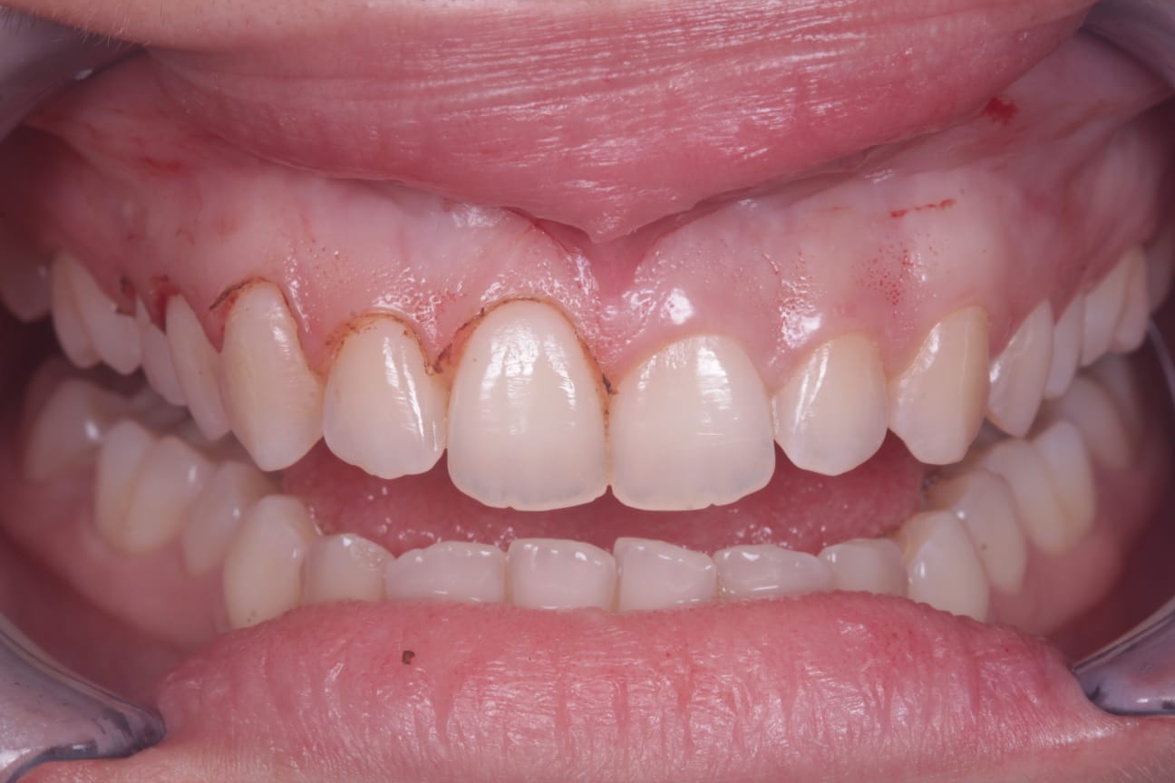 Antes - Vista Lateral