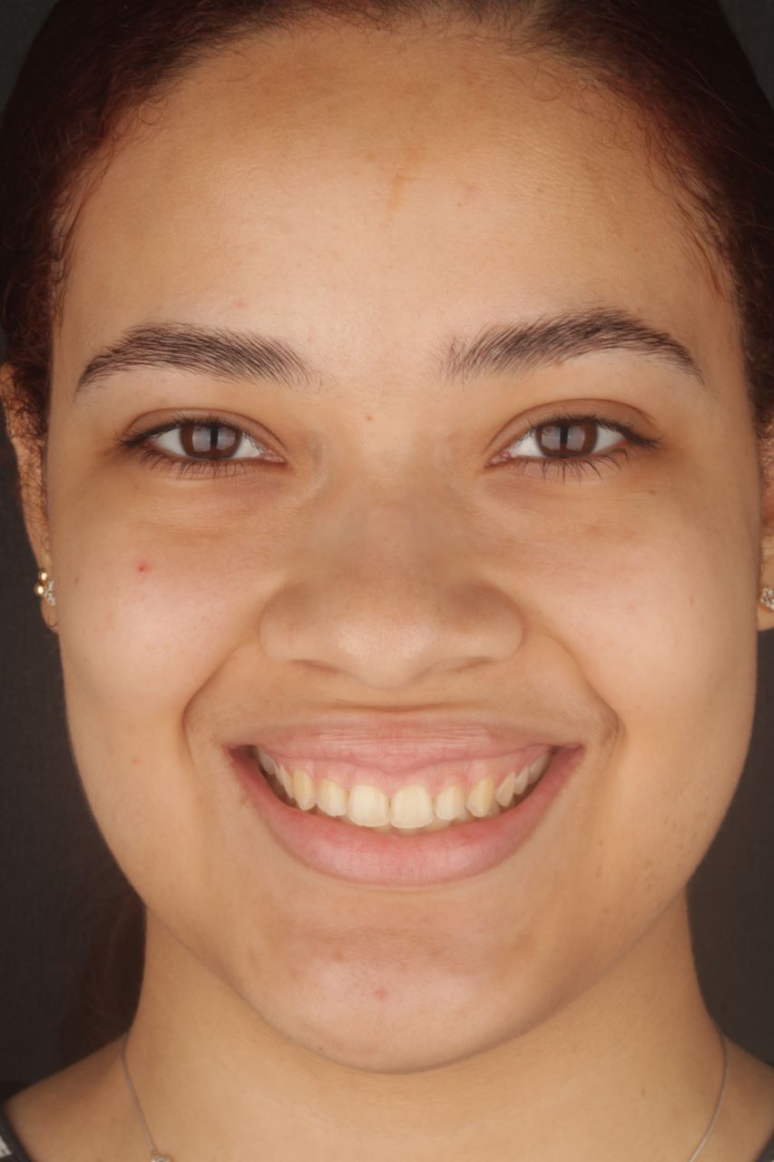 Antes - Vista Frontal