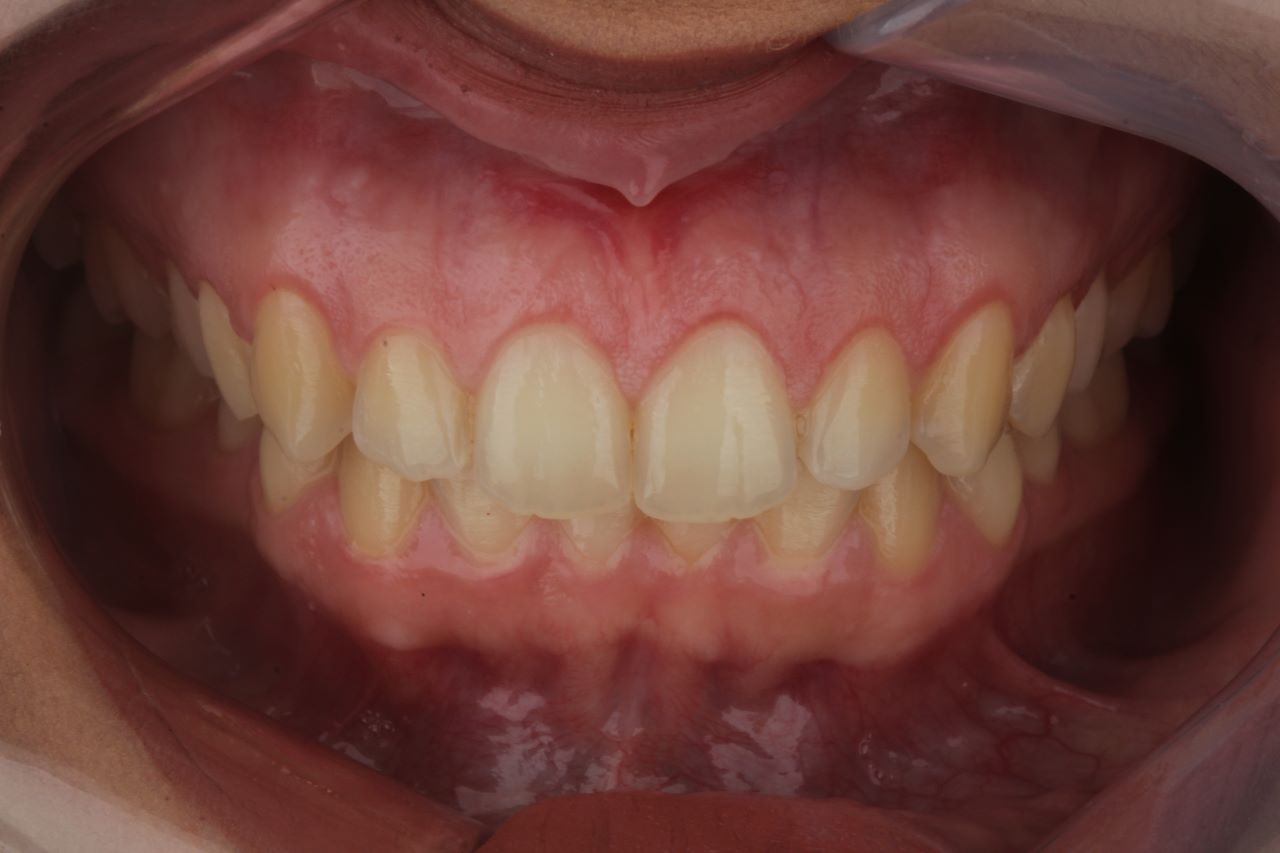 Después - Vista Lateral