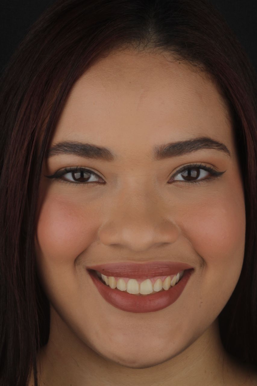 Después - Vista Frontal