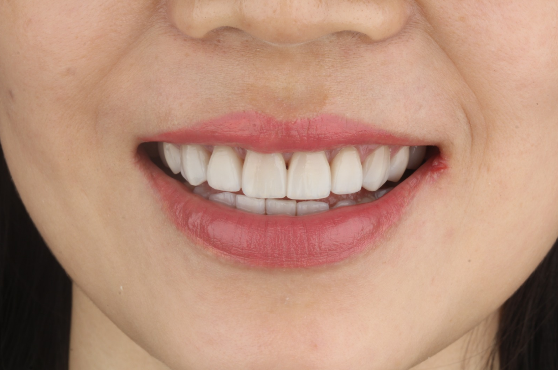 Después del tratamiento de odontología estética