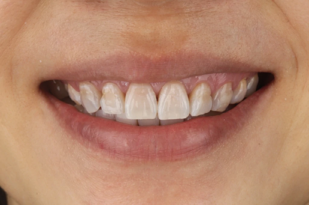 Antes del tratamiento de odontología estética