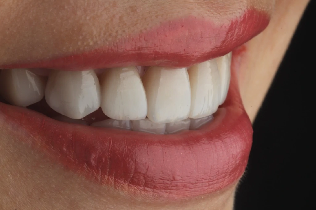 Después del tratamiento de odontología estética