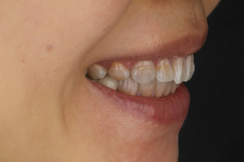 Antes del tratamiento de odontología estética