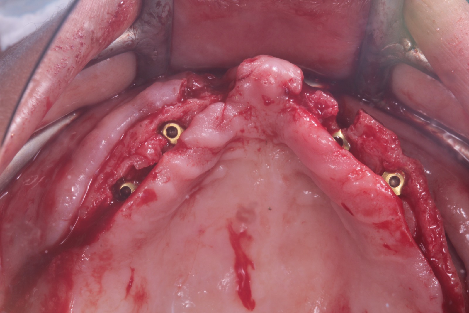 Antes del tratamiento de implantes dentales