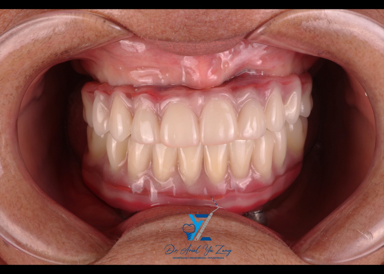 Después del tratamiento de implantes dentales