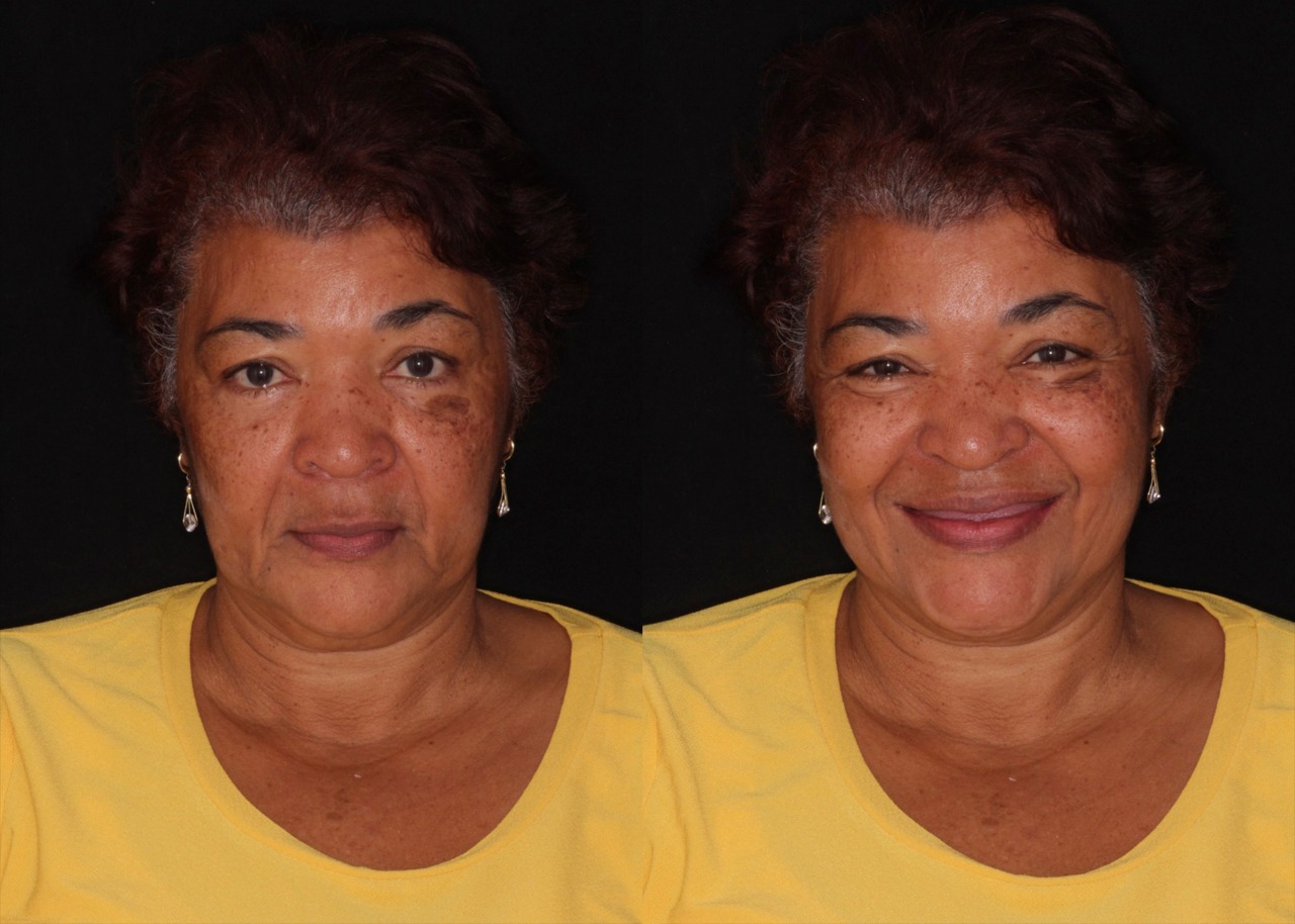 Resultado del tratamiento de implantes dentales