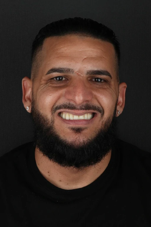 Resultado final del tratamiento de implantes dentales - Caso 2