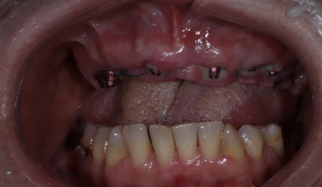 Resultado del tratamiento de implantes dentales - Caso 2