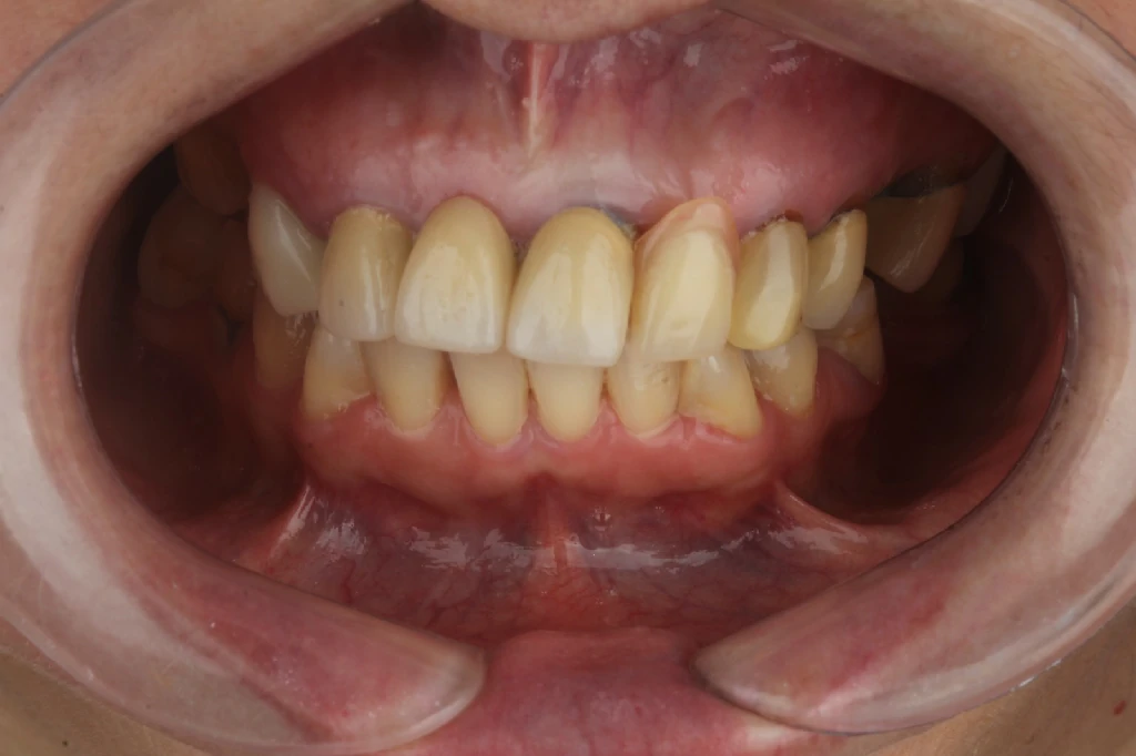 Antes del tratamiento de implantes dentales - Caso 3