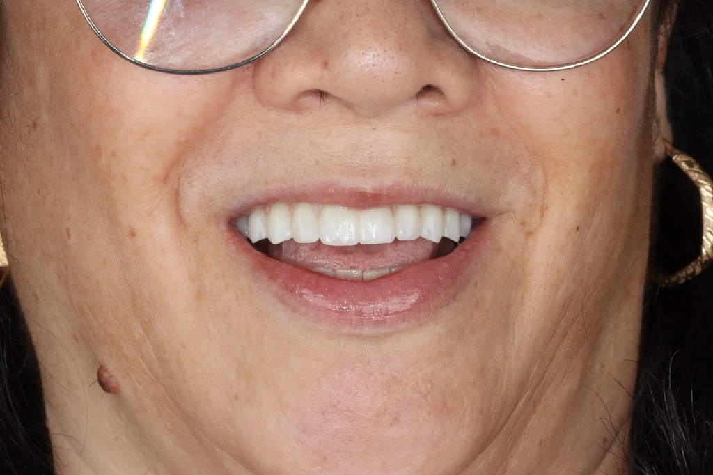 Después del tratamiento de implantes dentales - Caso 3