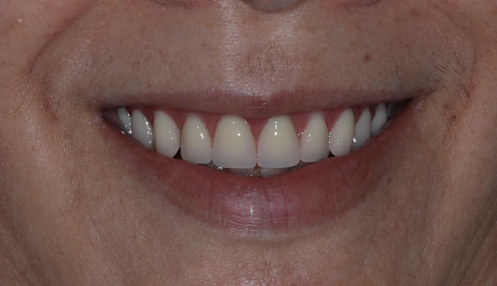 Después del tratamiento de implantes dentales - Caso 3