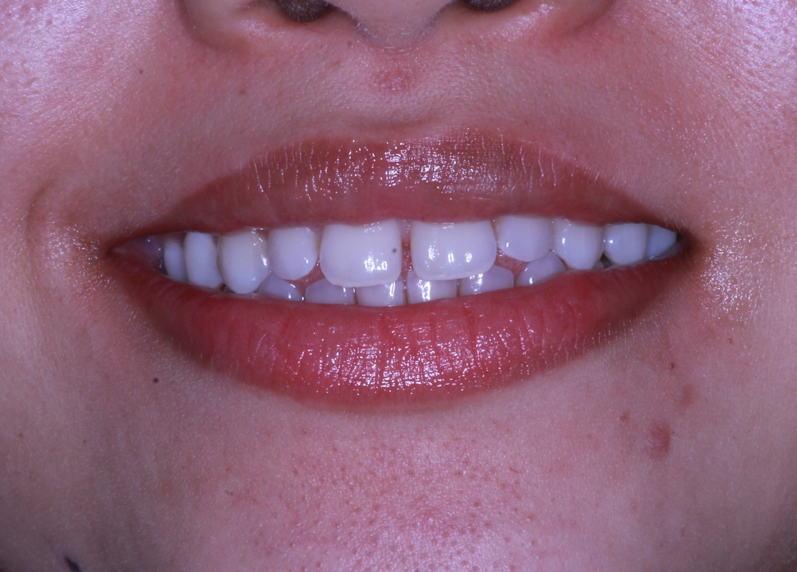 Antes del tratamiento de ortodoncia invisible - Caso 4