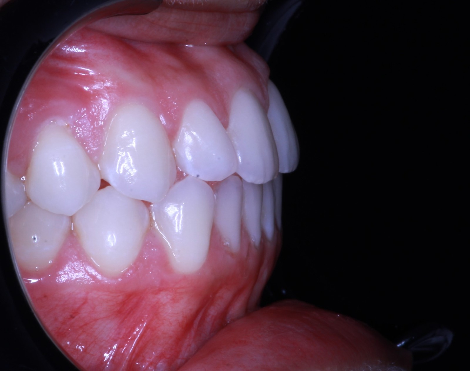 Antes del tratamiento de ortodoncia invisible - Caso 4