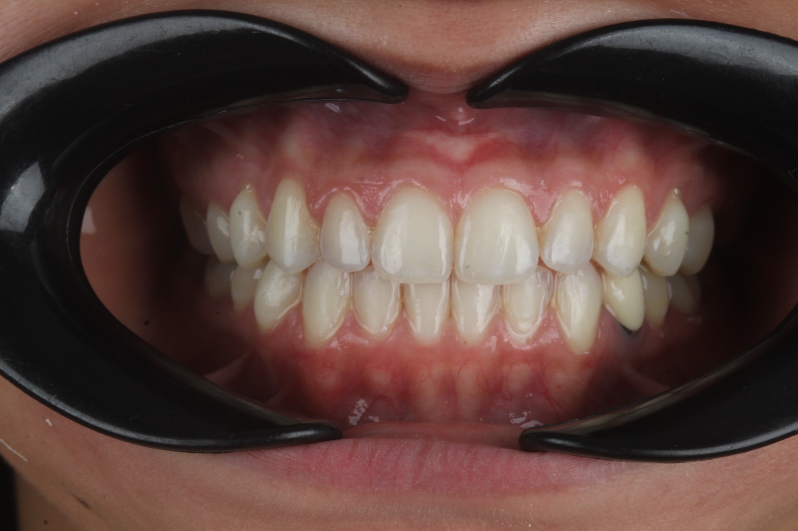 Después del tratamiento de ortodoncia invisible - Caso 4