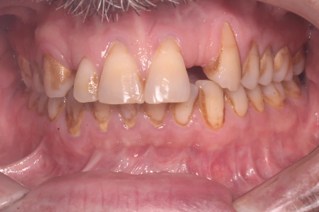 Antes de la limpieza dental profesional