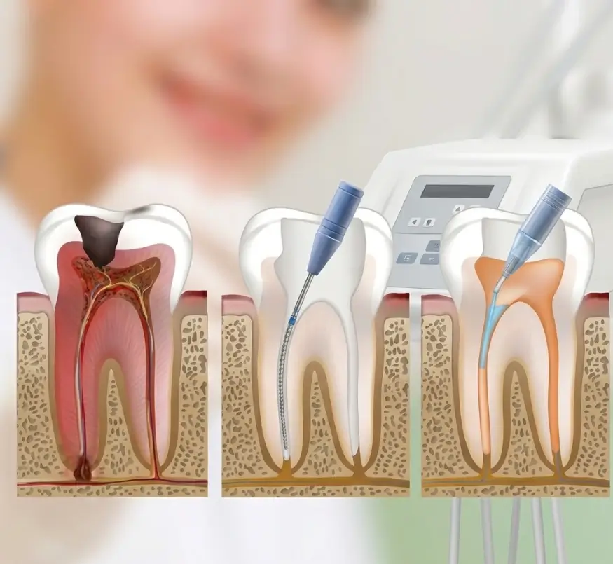 根管治疗 Santiago Lotus Dental